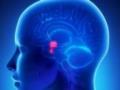Анализ крови поможет отличить мигрень от рака мозга