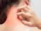 Симптомы Омикрона: врачи перечисляют три различных типа сыпи