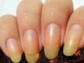 Желтые ногти расскажут о многих болезнях