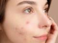 Ефективні методи використання ефірних олій для боротьби з прищами на обличчі