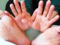 В Киеве фиксируют вспышку кори и гепатита А