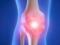 You need to know: what is the difference between arthrosis, arthritis and osteoporosis