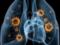 Вчені навчилися визначати туберкульоз по диханню
