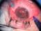 Єкатеринбурзькі офтальмологи врятували очей 10-річному хлопчикові після глибокого поранення осколком петарди
