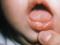 Виразки в роті у дітей: причини виникнення, як лікувати самостійно