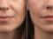 How to get rid of nasolabial folds