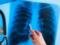 WHO: every fourth inhabitant of the Earth is a potential carrier of tuberculosis infection