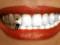 Стоматолог предупредила об опасности отбеливания зубов