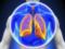 Ученые прогнозируют вспышку пневмонии в европейских клиниках