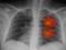 Scientists have found products that protect against lung cancer