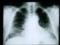 Too long and too short sleep are associated with an increased risk of pulmonary fibrosis