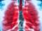 Не только кашель: названы признаки пневмонии, которые важно не пропустить