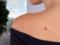 Oncologist: unsafe birthmarks are blamed on the singing houses of the body