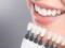 Teeth whitening: methods, advantages and recommendations